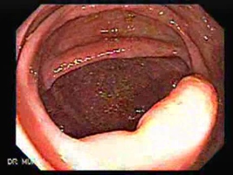 Adenocarcinoma of the Transverse Colon (5 of 5)