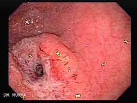 Adenocarcinoma of the Pre-pyloric Antrum (2 of 3)