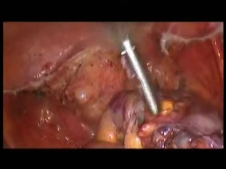 Tumor Mass Reduction In Advanced-Stage Cancer Of The Ovaries-Laparoscopic Approach