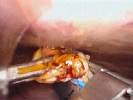 Colonic Perforation With Peritonitis - Laparoscopy (6 of 46)