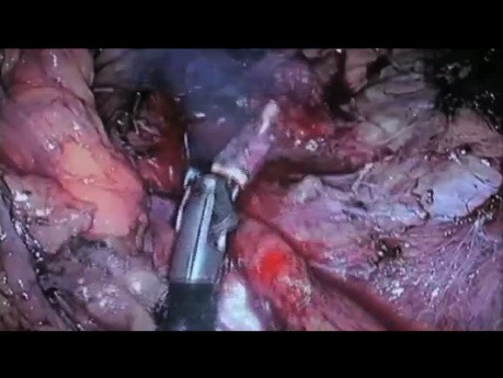 LESS Adrenalectomy for Left Adenoma