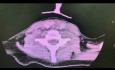 Acquired Subglottic Stenosis