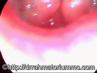 Hyperfunctional Voice