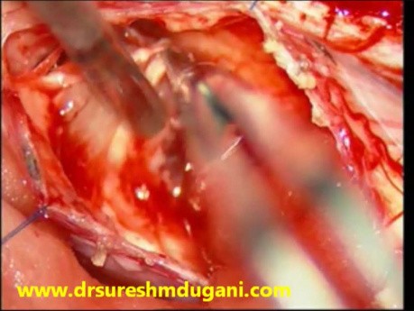 Cervical Spinal Cord Intramedullary Tumor - Microsurgical Excision