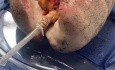 Modified EVLP Technique for Damaged Lung