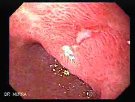 Two Ulcers in a Cirrhotic Patient - Follow Up Endoscopy, Part 1