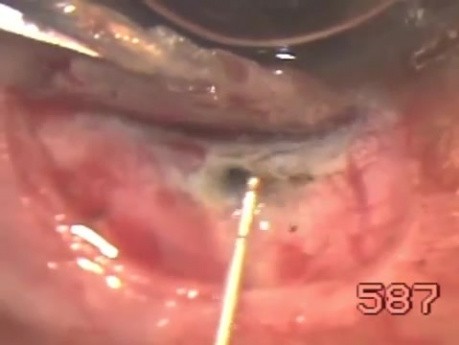 Leaking bleb excision