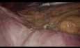 Laparoscopic Right Hemicolectomy with Intracorporeal Anastomosis Step-by-step Technique