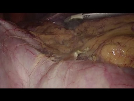 Laparoscopic Right Hemicolectomy with Intracorporeal Anastomosis Step-by-step Technique
