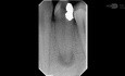Splitting Canal Mandibular Premolar
