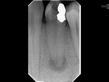 Splitting Canal Mandibular Premolar