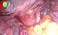 Test for Left Colon Injury