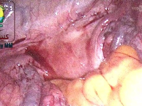 Test for Left Colon Injury