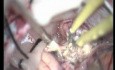 Hemispheric Cerebellar Astrocytoma - Suboccipital Approach
