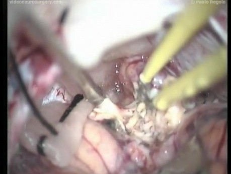 Hemispheric Cerebellar Astrocytoma - Suboccipital Approach