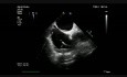 Pacemaker's Lead Thrombus