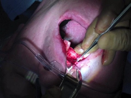 Bone Graft - Elevating Recipient Site Flap And Periosteal Release
