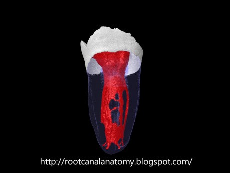 Mandibular Second Molar - 04 C-Shaped