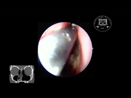 Inverted Papilloma Resection