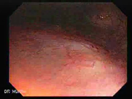 Colon Angiodysplasia (2 of 24)
