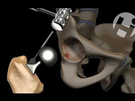 Future Hip Replacement