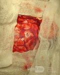 Decompressive Craniotomy