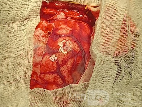 Decompressive Craniotomy