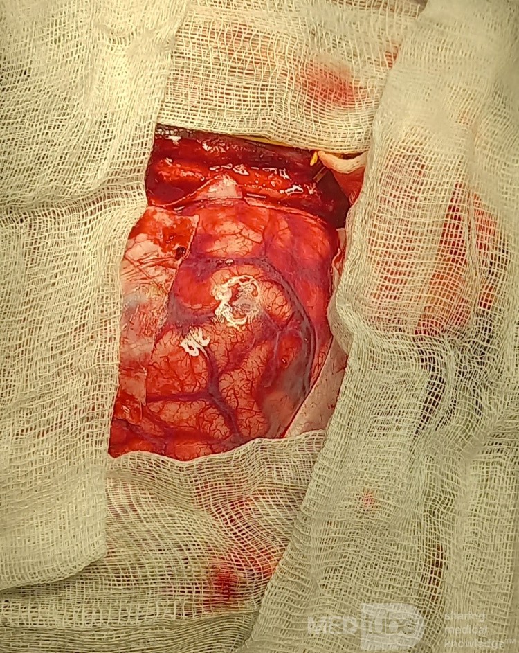 Decompressive Craniotomy