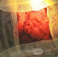 Meningocele in an 18-year-old patient