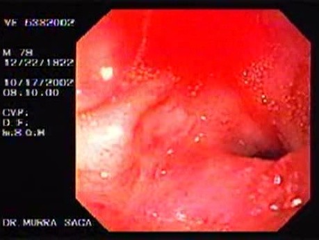 Duodenal Ulcer and Bleeding (2 of 4)
