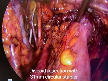 Discoid Resection with Histerectomy for Deep Endometriosis