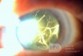 Neglected Traumatic Cataract with Old Hyphema
