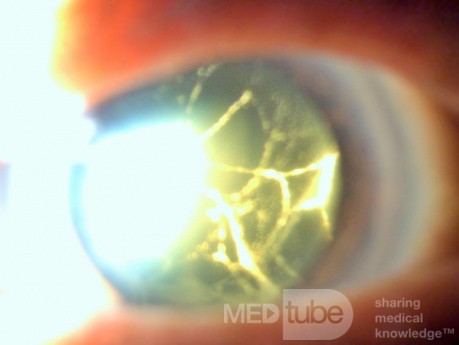 Neglected Traumatic Cataract with Old Hyphema