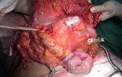 Metastasis of Renal Carcinoma to the ascending colon (6 of 11)