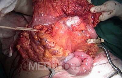 Metastasis of Renal Carcinoma to the ascending colon (6 of 11)