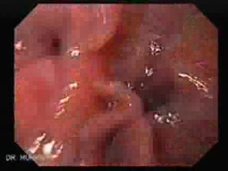 Scirrhous Gastric Carcinoma - Endoscopy (47 of 47)