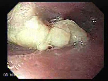 Esophageal Squamous Cell Carcinoma of the the Upper Third of the Esophagus that Invaded the Subglottis - 75 Years-Old Woman