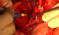 Open Para Aortic Lymphadenectomy