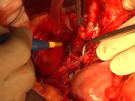 Open Para Aortic Lymphadenectomy