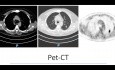S2 - LSE - Robotic Resection