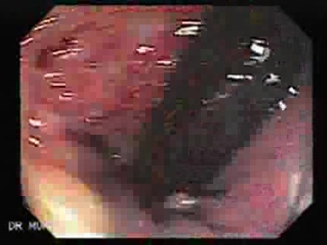 Endoscopic Resection of Giant Tubulo-Villous of the rectum (30 of 35)