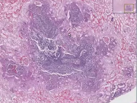 Pseudomonas abscesses