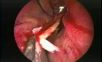 Nasal Septoplasty - Endoscopy