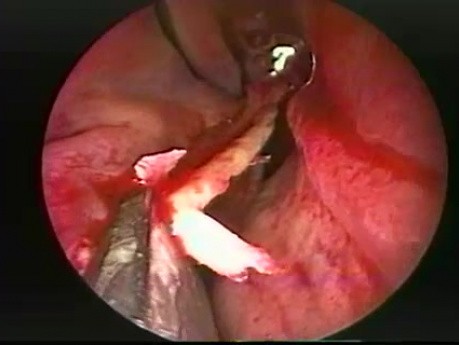 Nasal Septoplasty - Endoscopy