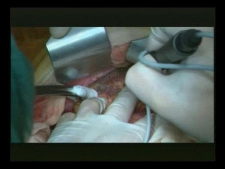 Right Open Hemicolectomy – Technical Principles - Part 1