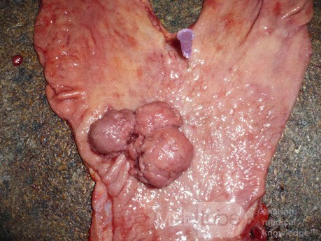 Polypoid Adenocarcinoma (1 of 9)