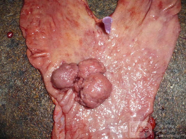 Polypoid Adenocarcinoma (1 of 9)