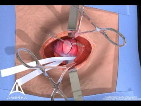 Inguinal Hernia Surgery 3D Medical Animation - Open Procedure