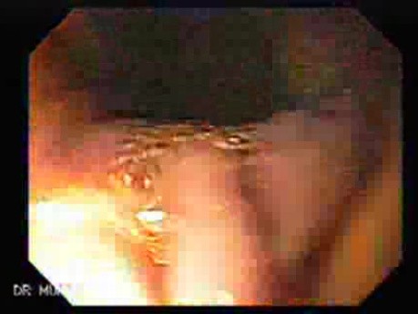 Gastric Adenocarcinoma With Varices - Endoscopy (6 of 8)