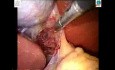 Single Incision Laparoscopic Cholecystectomy